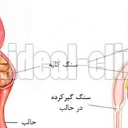 دفع سنگ کلیه با طب سنتی