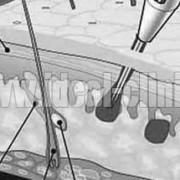 مزوتراپی برای لاغری موضعی