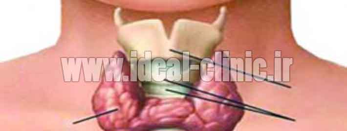 این علامت نشان دهنده تیروئید است