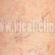 تغذیه در واریس