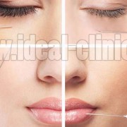 ژل اسید هیالورونیک