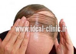 ویتامینهای جلوگیری کننده از ریزش مو