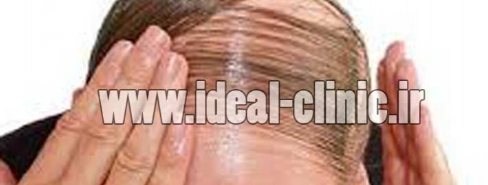 ویتامینهای جلوگیری کننده از ریزش مو