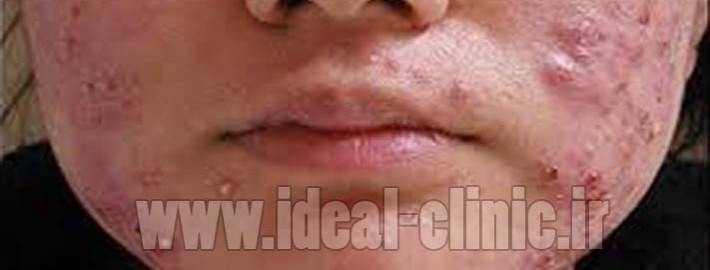 معجزه آویشن در درمان آکنه