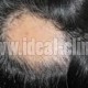 گیاهان دارویی و ریزش مو